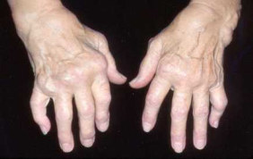 arthritis treatment