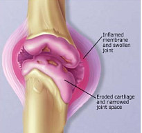 arthritis treatment